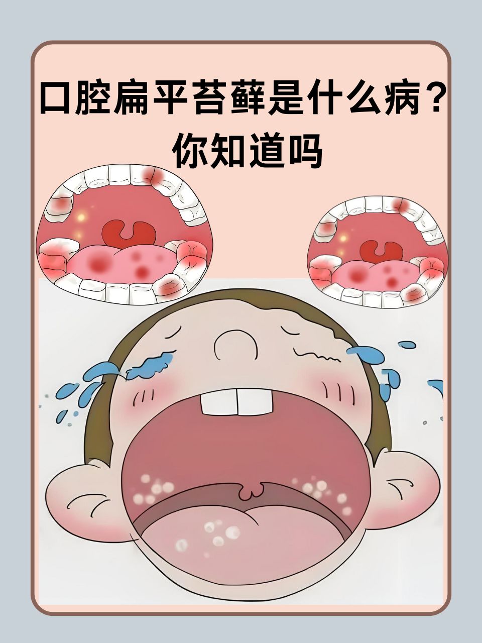 口腔扁平苔藓与白塞氏病 两种易混淆的口腔黏膜疾病解析