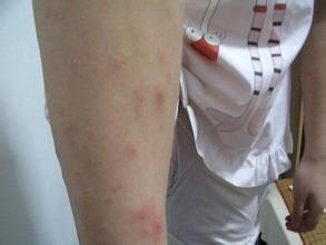 白塞氏病会遗传给孩子吗？