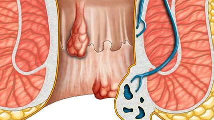 口腔白塞氏病的治疗方法