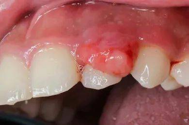 秋冬季反复烂嘴、口腔溃疡怎么办？警惕白塞氏病的信号