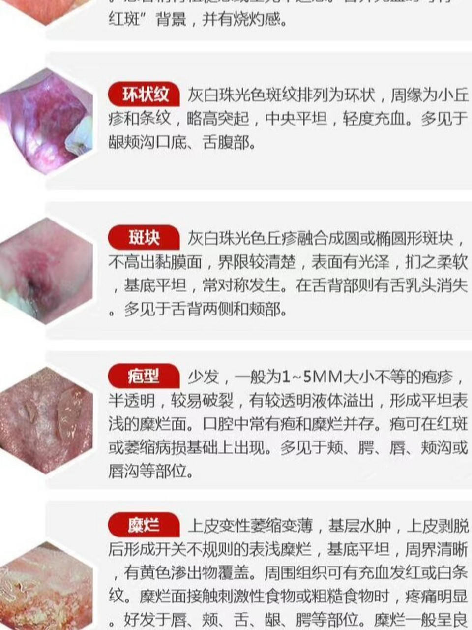 口腔黏膜上的‘白色警报’ 扁平苔藓、白斑与白塞氏病，你了解多少？