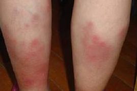 白塞病与生育 全面解析与科学建议